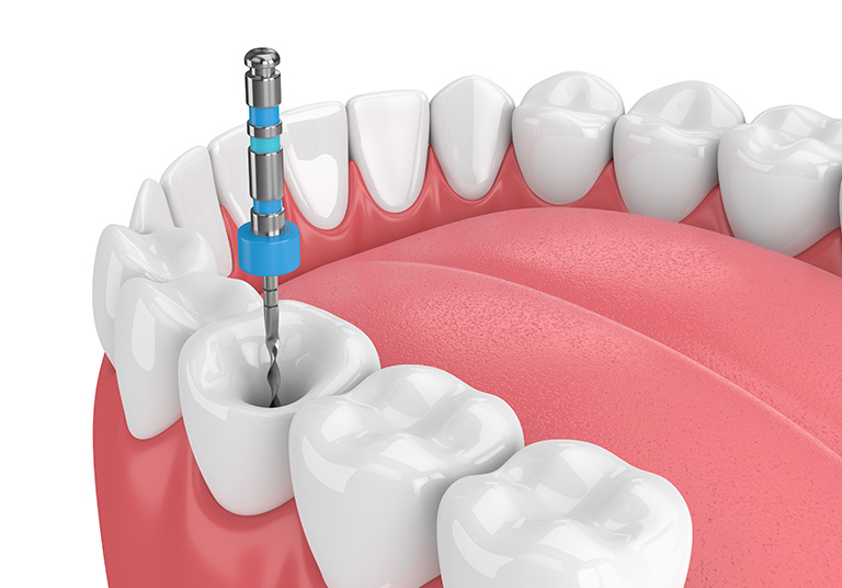 Root Canal Treatment