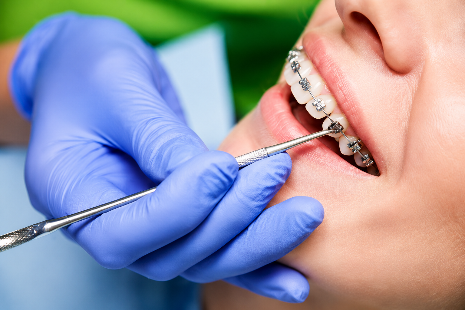 Dental Braces
